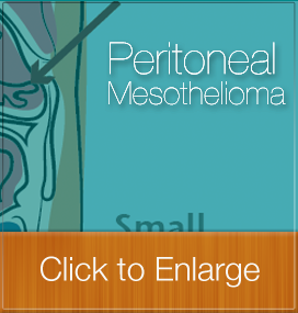 Peritoneal Mesothelioma Visually Explained